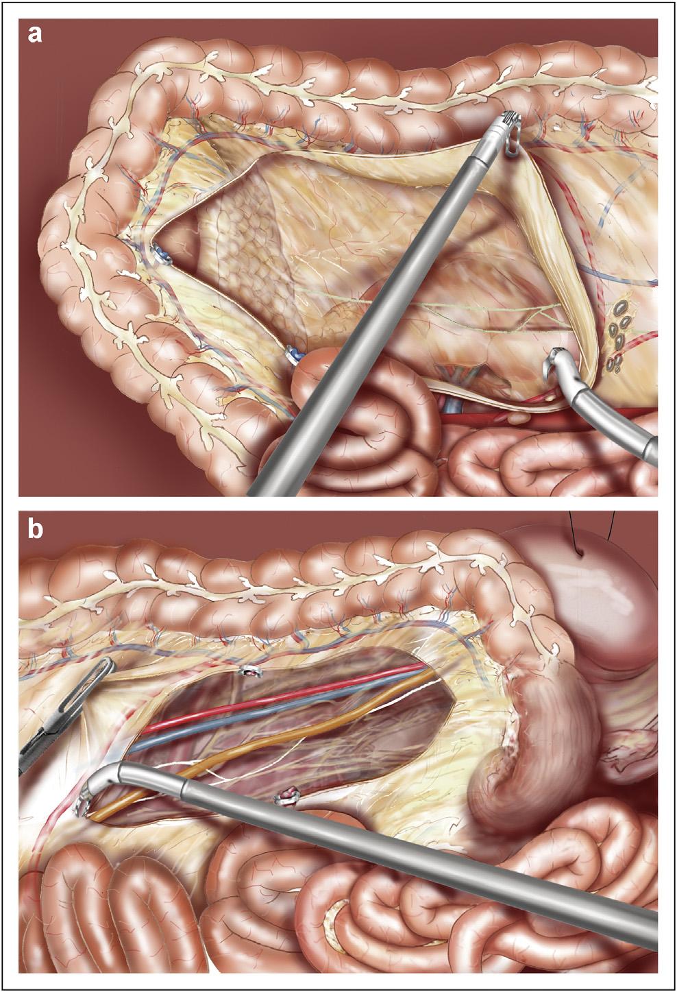 384 A. Valverde et al. 9 Console-directed surgery: second step of the abdominal procedure The left mesocolon is freed from medial to lateral taking care to respect the pre-renal fascia.