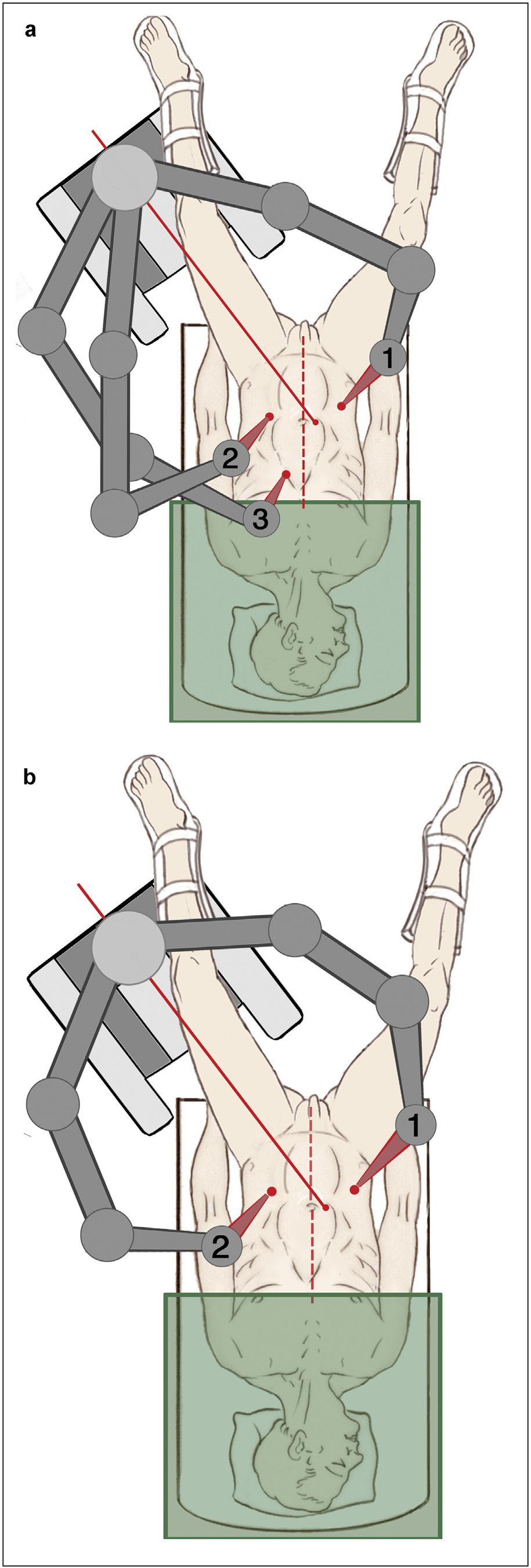 Robot-assisted laparoscopic rectal resection 385 11 Console-directed surgery: the pelvic dissection While the initial robotic set-up may be adequate for complete pelvic dissection in certain