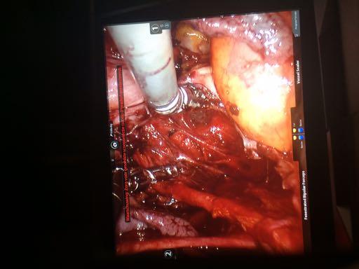 Vessel Sealer for opening%para> rectal space Identification of% splanchnic