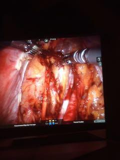 Node%Dissection