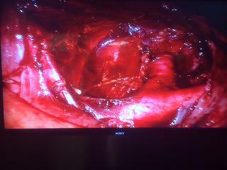 Left Ureter' Inferior Mesenteric Artery