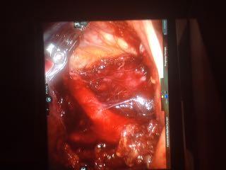 Right'Ureter Aorta