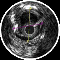IVUS identified the vessel diameter thus assisting the physician to appropriately pre-dilate the
