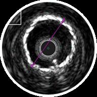 IVUS identified the proximal vessel diameter and where the normal proximal segment of the vessel