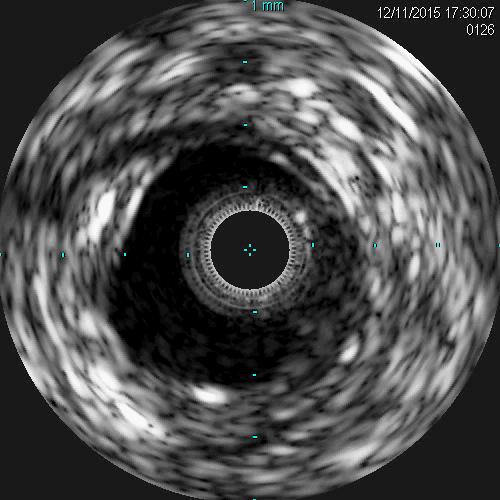 Post IVUS After Treatment Post therapy IVUS