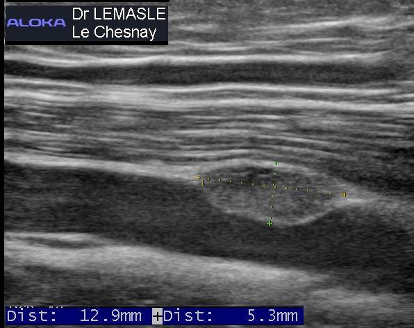 vascular duplex scan lower limbs tissue tumefaction developped in the venous wall