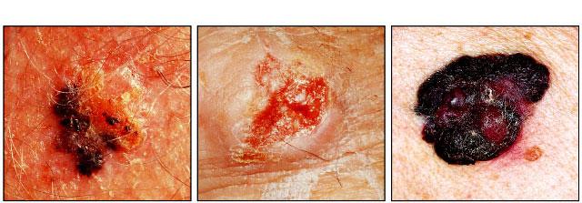 Integumentary Aging and Disease 30 SKIN CANCER