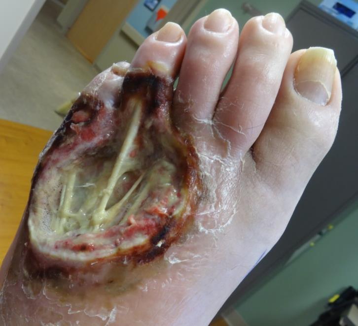 Complex Wounds: Exposed Bone/Tendon