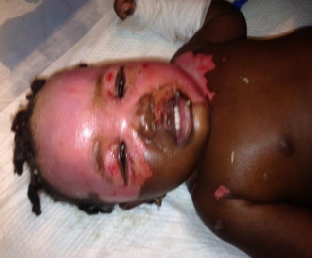 Pediatric Partial-Thickness Burn Toddler presented with a partial-thickness, typical scald burn on
