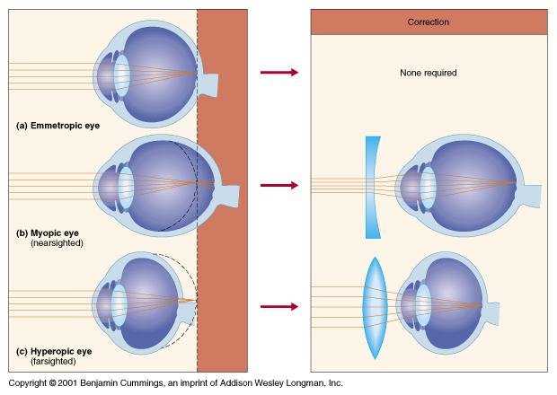 Refractive Disorders Normal eye Myopic eye Hyperopic eye Myopia nearsightedness caused by an eyeball too long for the convexity of the lens. The correction is a concave lens to reduce convergence.