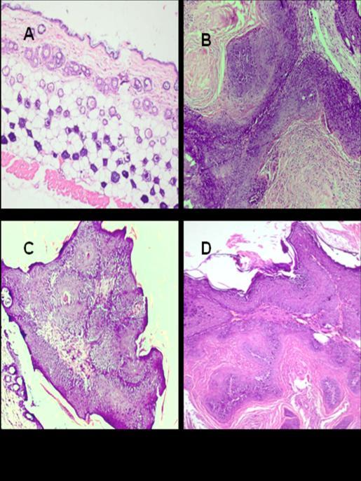 Fig. 9 and 10, Effect of silibinin on tumor development and tumor histopathology Table 2.