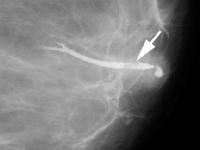 Nipple Discharge Evaluation A 42-year-old woman with serous discharge from her left nipple.