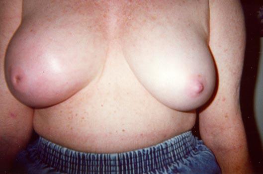 Enlarged right breast
