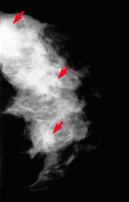 Fibrocystic Breast Tissue on a Mammogram Mammogram