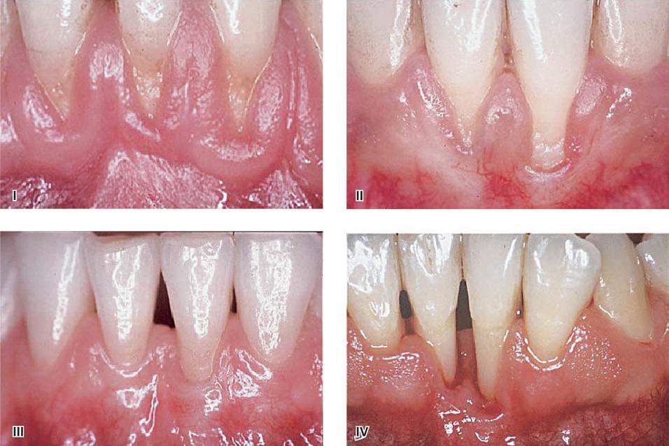 stepen prekrivanja korena zuba zavisi od nivoa ivice gingive dva susedna zuba, i to je realna projekcija ivice gingive nakon prekrivanja ogoljenog korena zuba.