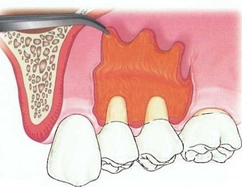 subepitelijalnog transplantata vezivnog tkiva prethodno pozicioniranog preko ogoljenog korena zuba, dok Harris 1992. 56 usavršava ovu tehniku.