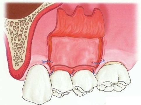 kojim se u potpunosti prekriva transplantat vezivnog tkiva fiksiran preko ogoljenog korena zuba.