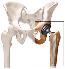 Total Hip Replacement Exercise Booklet Cemented Femoral Stem Weight Bearing As Tolerated Patient Name: