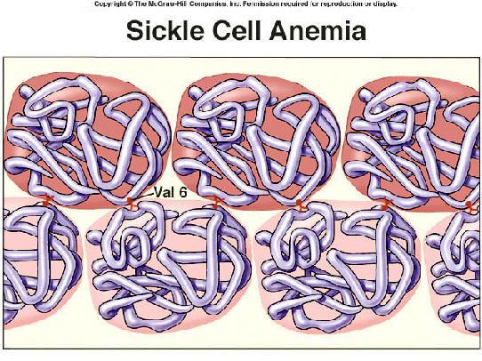 In sickle cell anemia, the normal hemoglobin molecule mutates by exchanging the 6th amino acid on the beta chain from glutamic acid to valine. Normal Hb has the genotype SS.