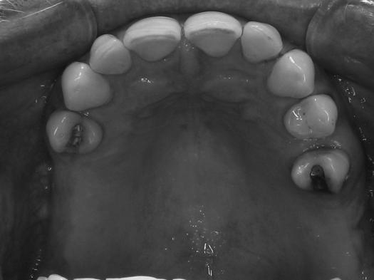 No clinically significant differences between subjects with shortened and complete dental arches with regard to: - masticatory ability signs and symptoms of TMJ disorders