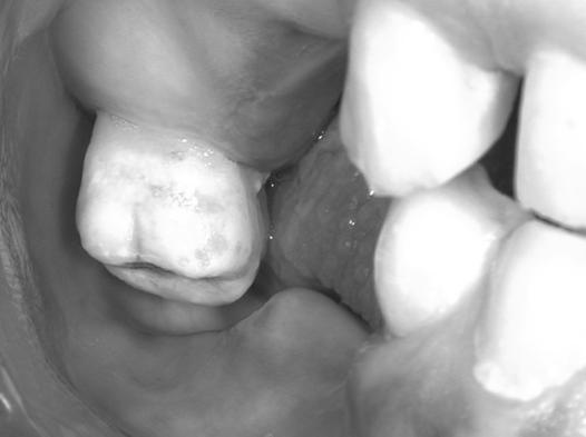 greater incidence of new and recurrent caries lesions in