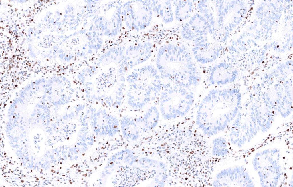 VENTANA MMR IHC Panel Interpretation Guide for Staining of Colorectal Tissue VENTANA anti-mlh1 (M1) Mouse Monoclonal Primary Antibody VENTANA anti-pms2 (A16-4) Mouse Monoclonal Primary