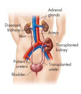 Kidney Disorders Kidney Failure In transplantation, a patient receives a kidney from a compatible donor.