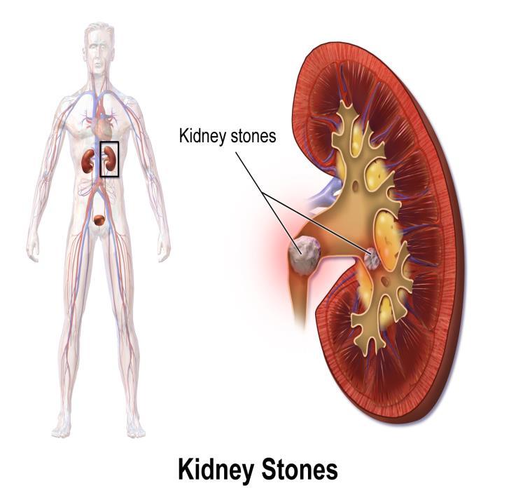 DISORDERS: ONE DISORDER IS CALLED KIDNEY STONES, THE SYMPTOMS INCLUDE: VOMITING OR NAUSEA