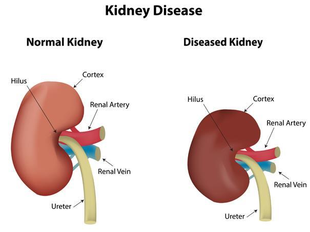 DISEASES: ONE DISEASE IS CALLED KIDNEY FAILURE. KIDNEY FAILURE CAN BE CAUSED WHEN YOUR KIDNEYS ARE DAMAGED BY A PATHOGEN INFECTION, SUCH AS STAPHALOCOCCUS.