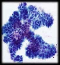 tumours and low grade serous carcinoma in cytological specimens is not robust: This distinction