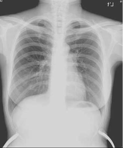 CHEST X-RAY Normal heart size No abnormal radiopaque densities at