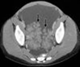 Axial contrast-enhanced CT section through the pelvis showing the