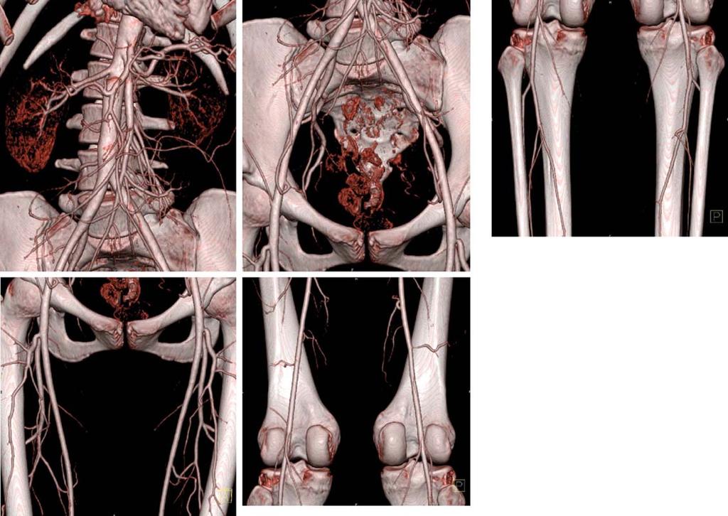 1120 hiatt et al Fig. 1. CT angiography of normal lower extremities. Note the absence of any lesion or stenosis affecting the arteries.
