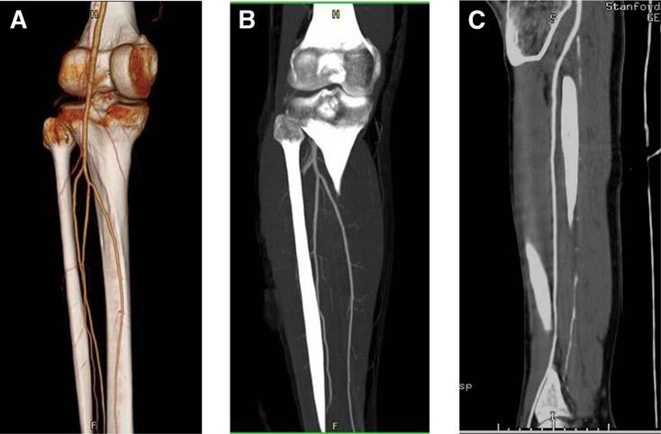 1122 hiatt et al peripheral artery disease may have widely varying times of transit of contrast material from the intravenous injection site to the peripheral arteries.