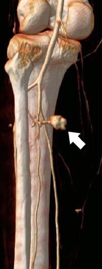 The femorofemoral graft was completely occluded except for a 2-cm segment at its most proximal right aspect.