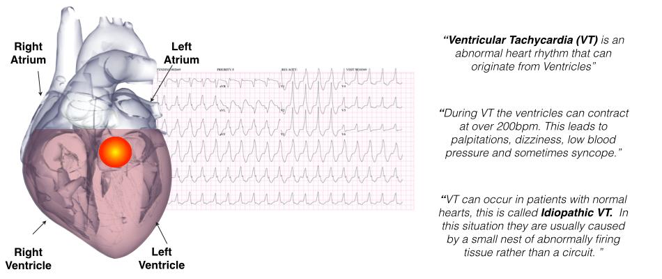 Melbourne Heart Rhythm Ventricular Tachycardia in Structurally Normal Hearts (Idiopathic VT) Patient Information What is Ventricular Tachycardia?