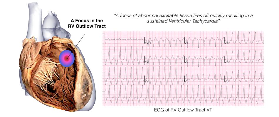 Ventricular Tachycardia in Normal Hearts (Idiopathic VT) VT can also occur in patients with normal hearts, so-called Idiopathic Ventricular Tachycardia and this accounts for about 10% of all VTs.