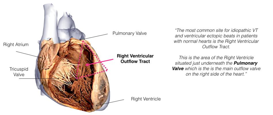 Idiopathic VT is usually due to a small nest (focus) of overly excitable heart tissue that fires of erratically, like a muscle twitch.