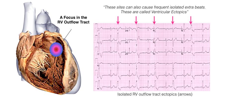 Some idiopathic VTs also form in the aortic valve (aortic cusps) or just beneath the aortic valve in the left ventricle, these are called left ventricular outflow tract VT (LVOT-VT).