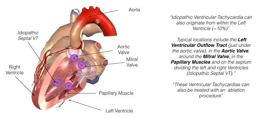For RVOT VT medications may be prescribed to suppress VT such as beta-blockers (Metoprolol or Atenolol) or calcium channel blockers (Verapamil or Diltiazem), however these medications only have a