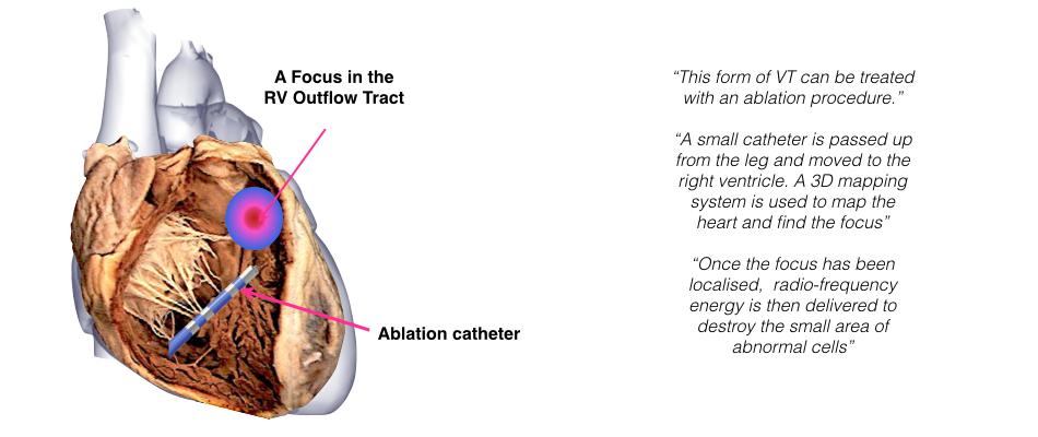 Catheter Ablation Therapy What to Expect Before and After Ablation You will may need to stop taking any medication that you have been prescribed for your abnormal heart rhythm 5 days prior to your