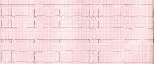 Negative P waves correspond to long RR cycles>>junctional escape beats Occasional premature beats P waves: intermittent; morphology variable Diagnosis: Sick sinus syndrome Differentiate