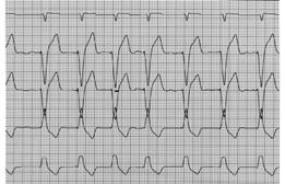 ECG #9 12 year old DSH; no clinical signs 25 mm/sec; 1 mv= 1 cm HR@100 bpm ECG #9 12 year old DSH; no clinical signs 25 mm/sec; 1 mv= 1 cm HR@100 bpm RR regularity: regular QRS morphology: normal