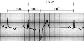 Therefore, normally in lead II, the P wave is positive and the QRS is predominantly