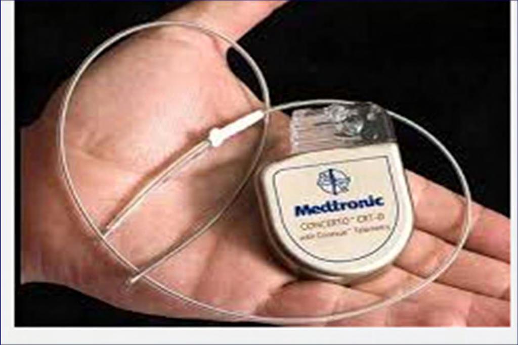Implantable Cardioverter Defibrillator 6v battery Delivers 700v shock Defibrillates