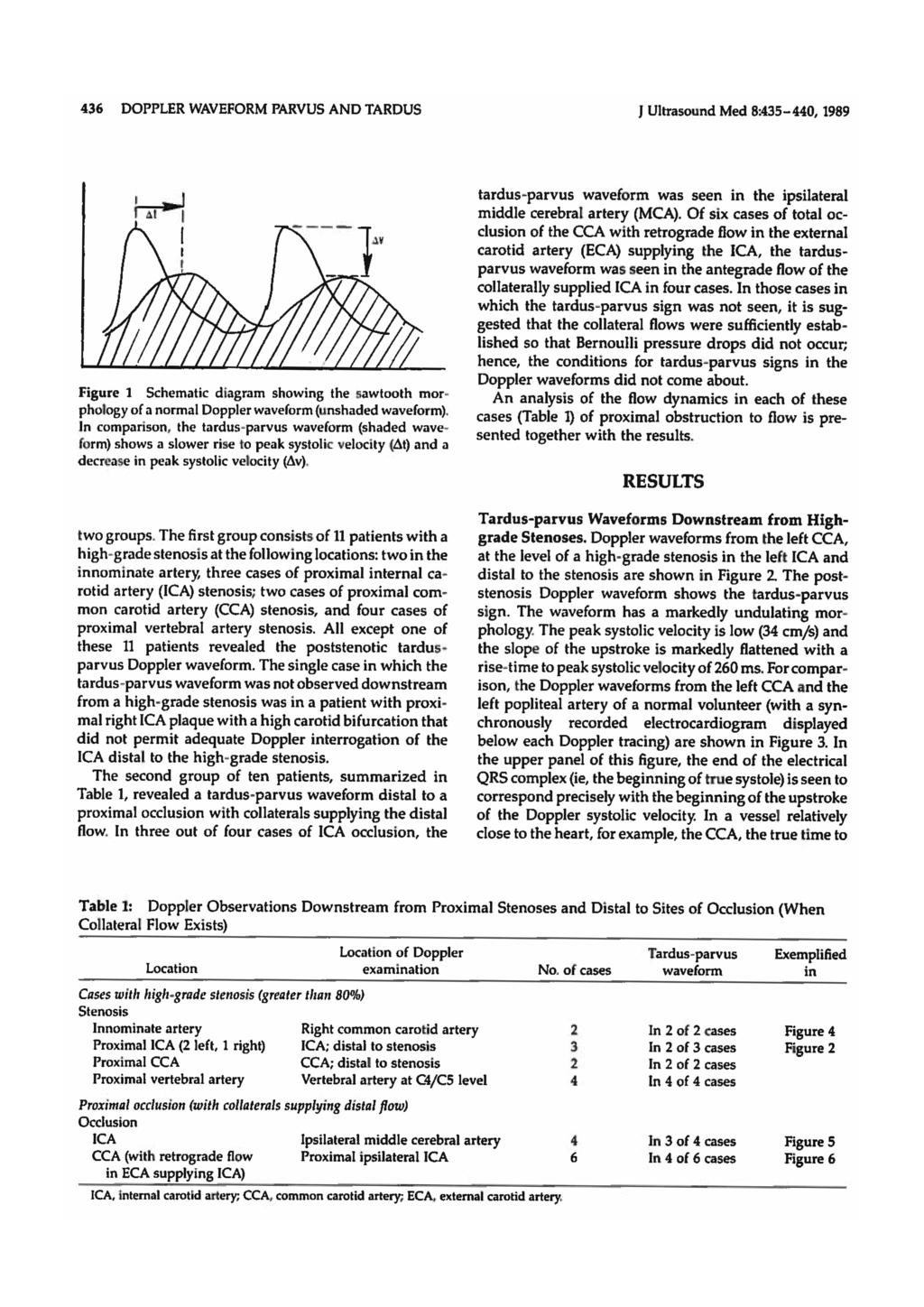 436 DOPPLER WAVEFORM PARVUS AND TAROUS ~ t Figure 1 Schematic d iagram showing the sawtooth mor photogy of a normal Doppler waveform (unshaded waveform).