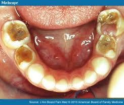 They occur when the enamel softens and then breaks down,