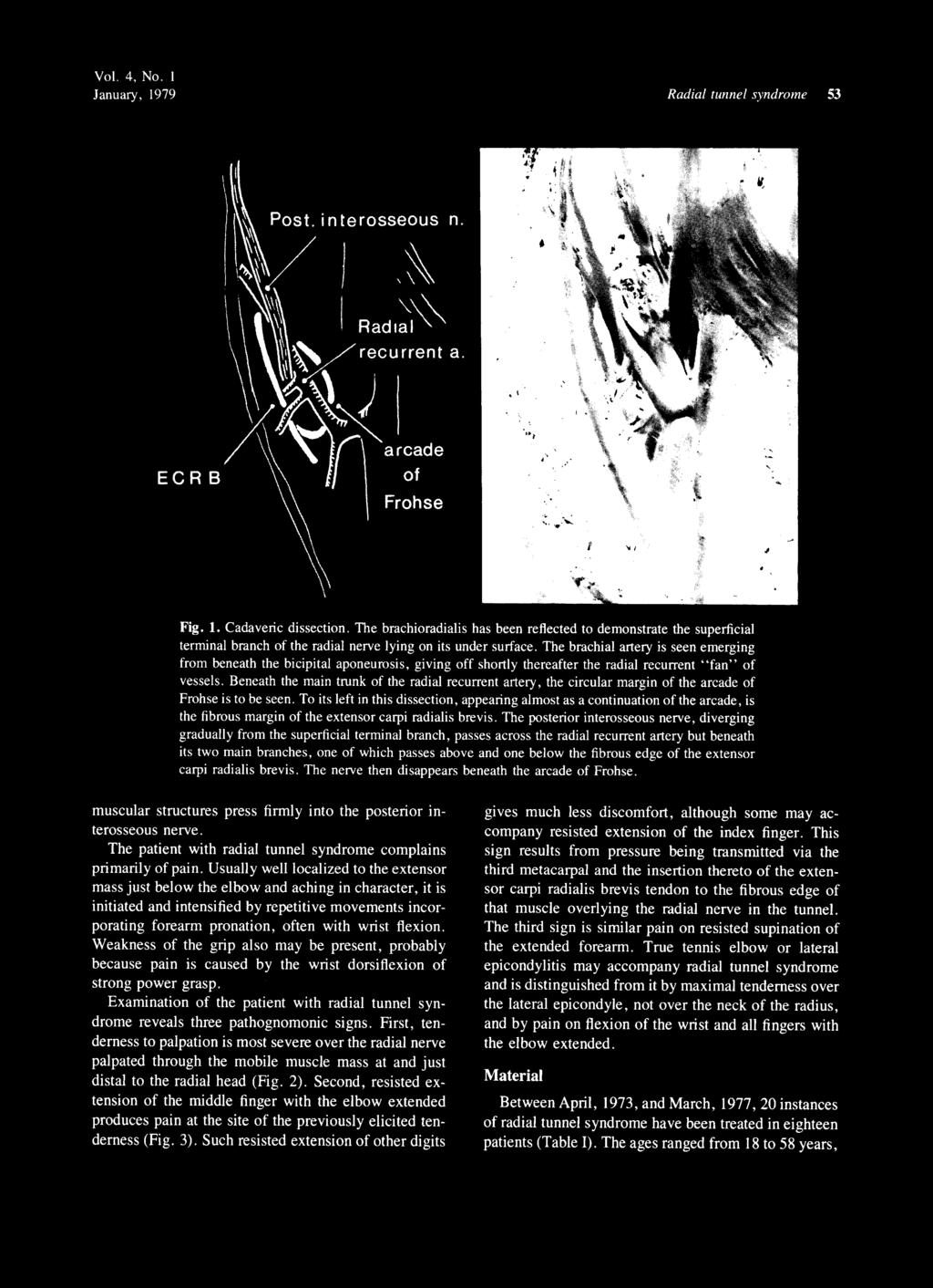 Vol. 4, No. I January, 1979 Radial tunnel syndrome 53 n. ECR rohse ig. 1. Cadaveric dissection.