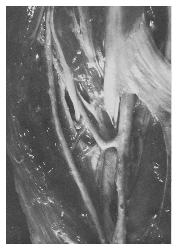 The brachial artery is seen emerging from beneath the bicipital aponeurosis, giving off shortly thereafter the radial recurrent " fan" of vessels.