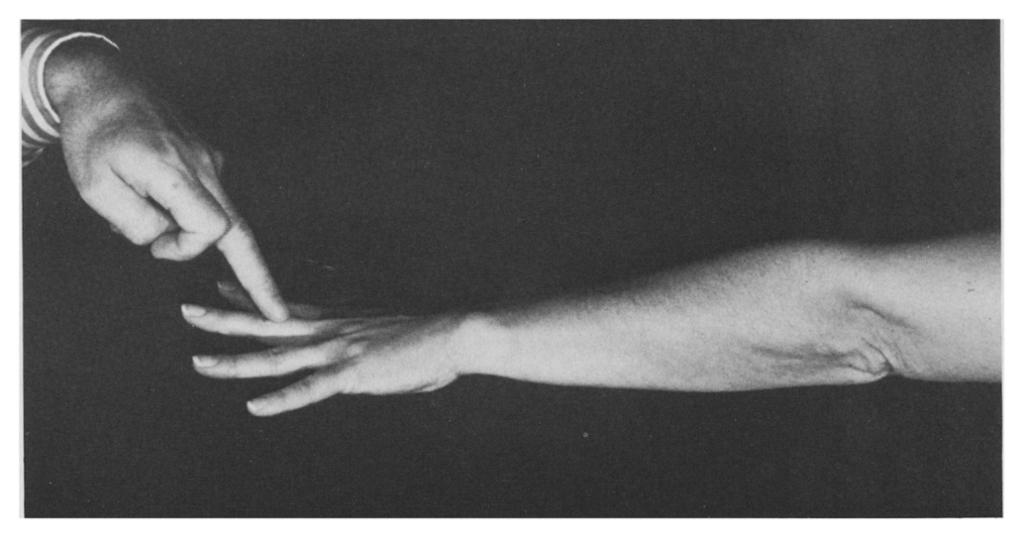 Similar pressure over other fingers may cause some pain but not as severe. (rom Lister GD: The hand: Diagnosis and indications, by permission of the publishers, Churchill-Livingstone, Ltd.